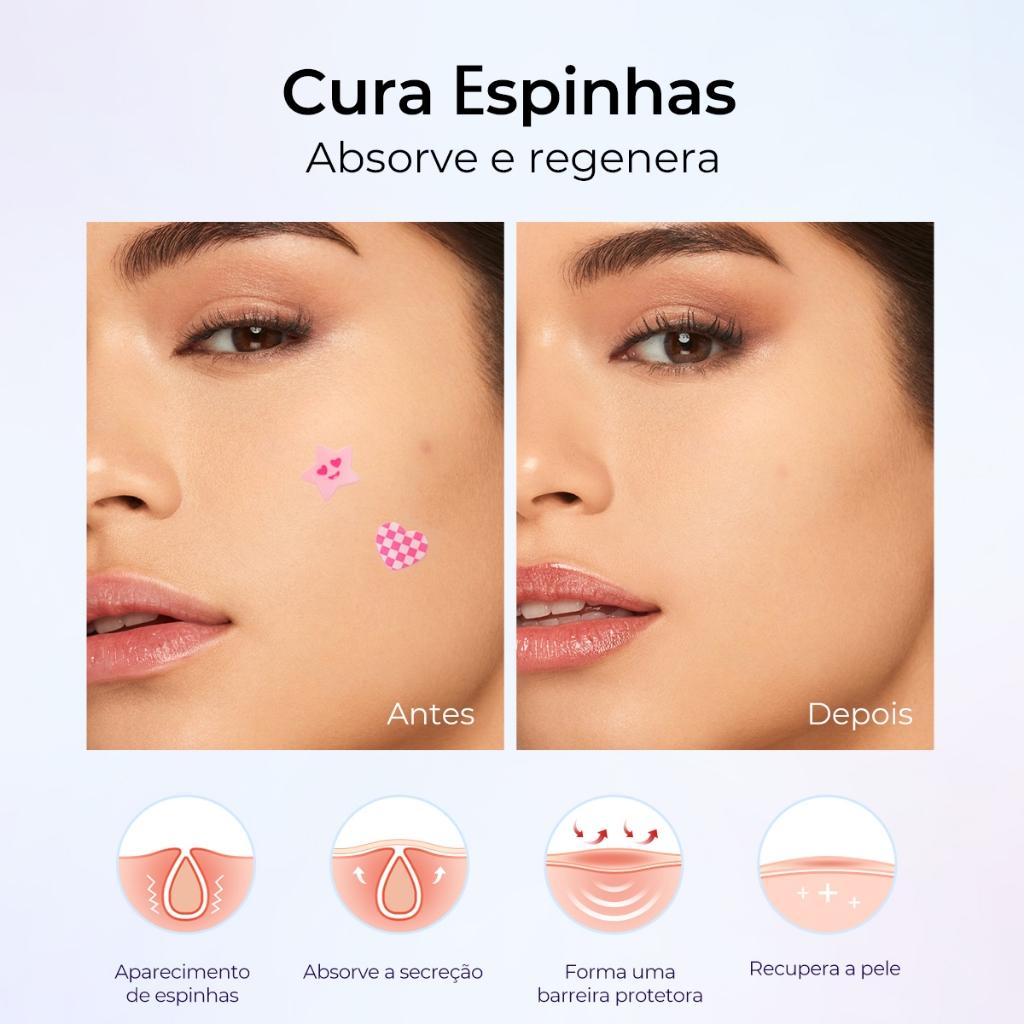 Adesivos Para Acne Sace Lady Reparação Da Acne Tratamento Para Manchas Cuidados Com A Pele
