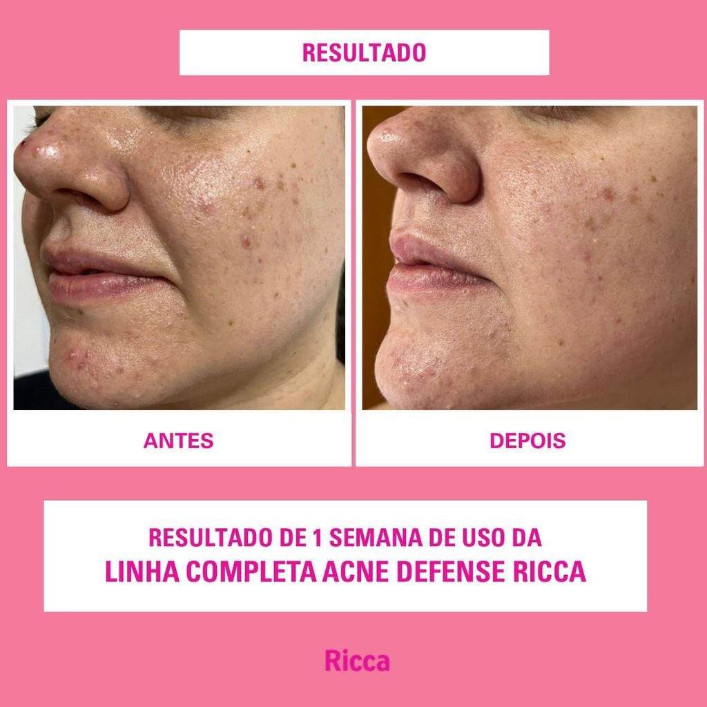 Tônico Facial Acne Defense Ricca